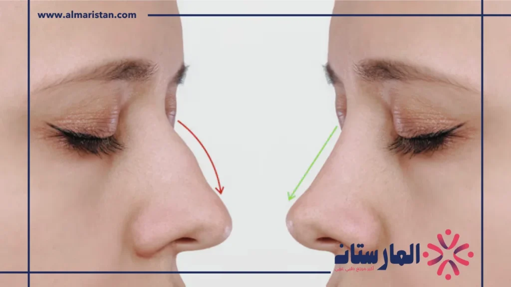 أنواع عمليات تجميل الأنف