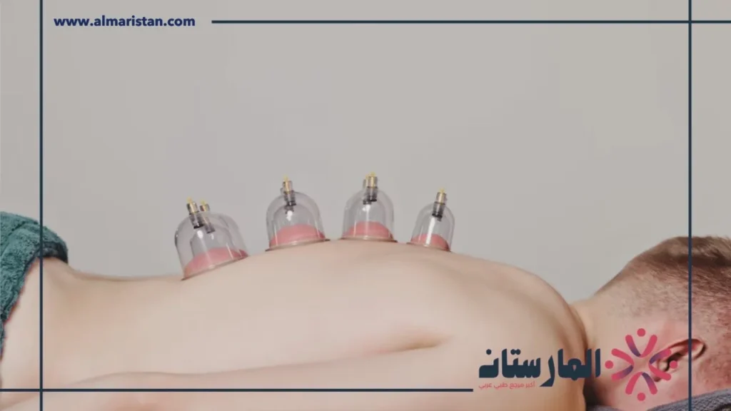 التدخين بعد الحجامة التدخين بعد الحجامة