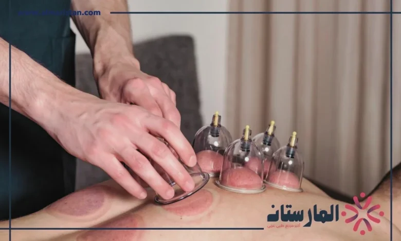 التدخين بعد الحجامة