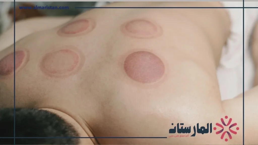 الحجامة الهوائية الحجامة الهوائية