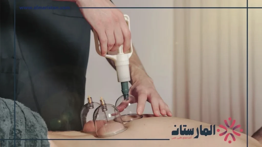 الحجامة الهوائية (2) الحجامة الهوائية