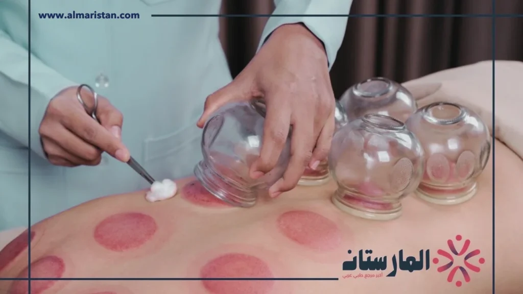 الحجامة الهوائية (3) الحجامة الهوائية