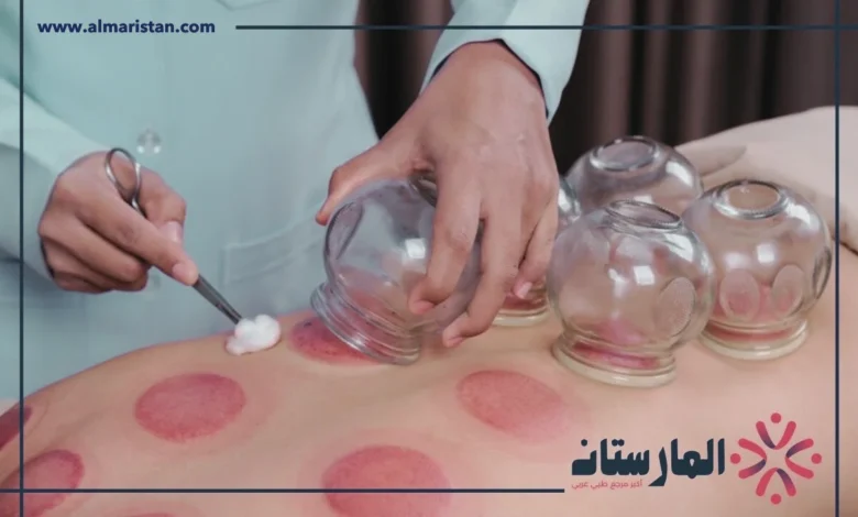 الحجامة الهوائية