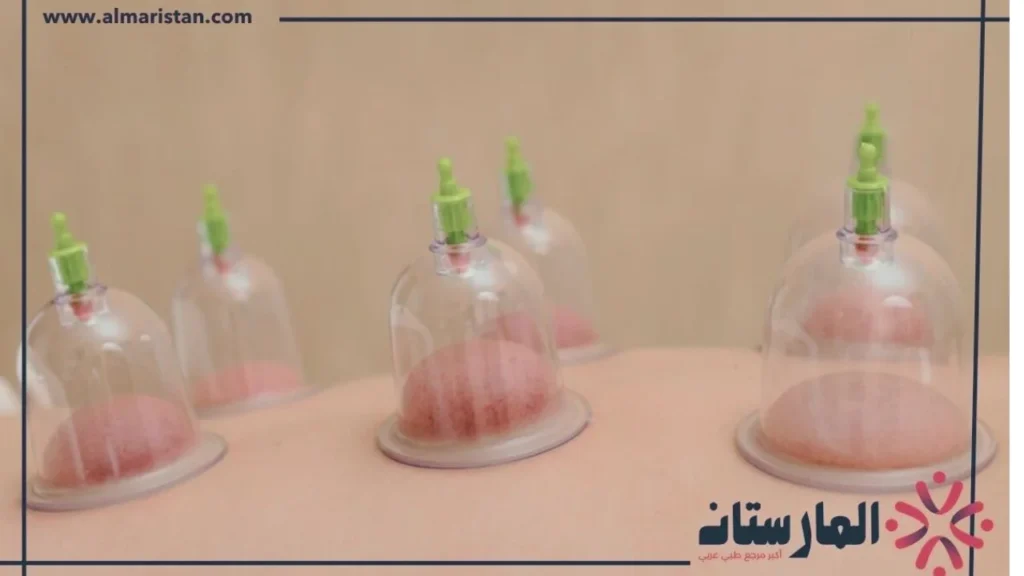 الحجامة على ظهر القدم