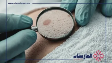 تجربة لقاح جديد لسرطان الجلد في بريطانيا