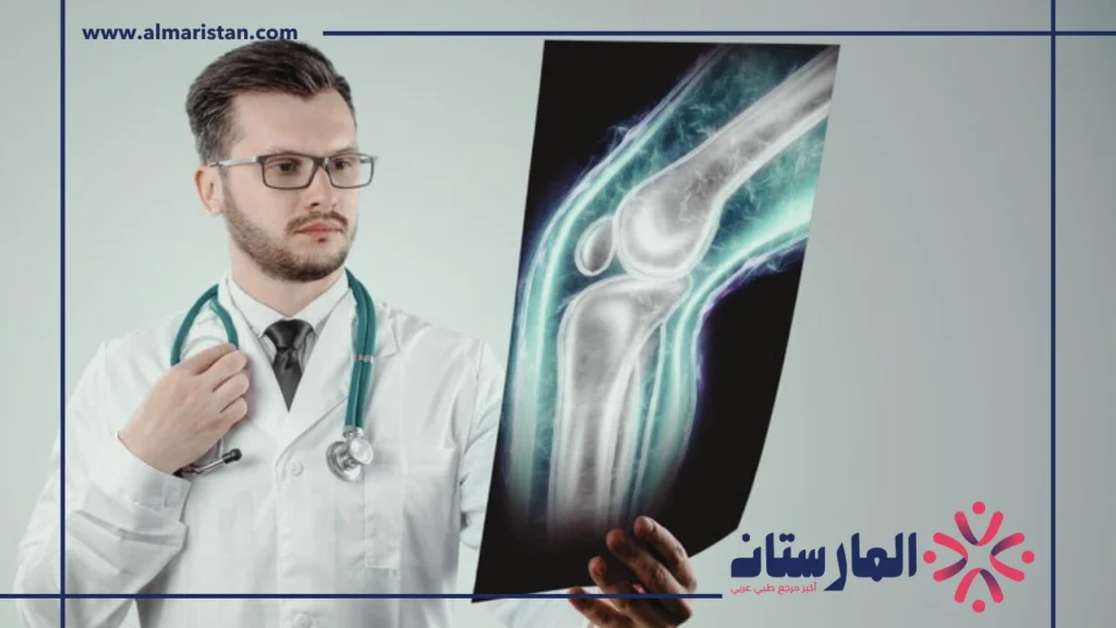 علاج خشونة المفاصل