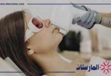 ليزر الوجه