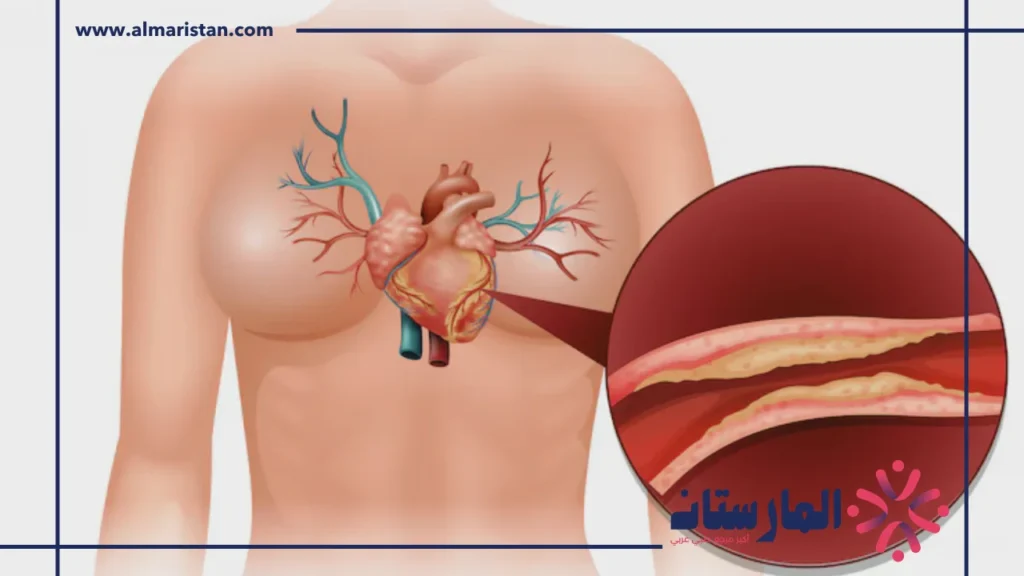 أعراض انسداد الشرايين
