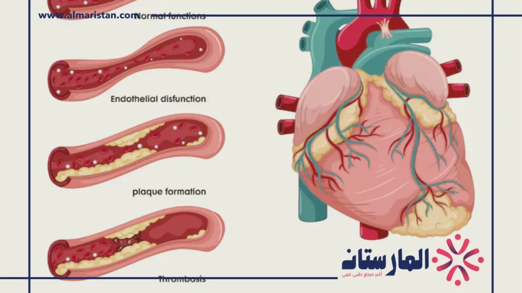 أعراض انسداد الشرايين