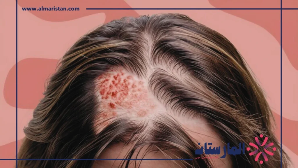 أعراض التهاب فروة الرأس