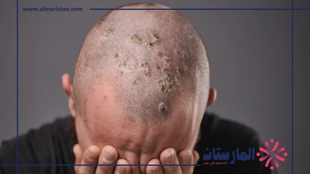 أعراض التهاب فروة الرأس