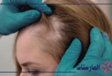 الفرق بين الثعلبه وفراغات الشعر