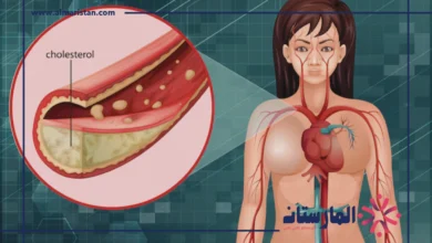 انسداد الشرايين عند النساء