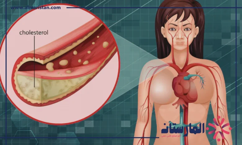 انسداد الشرايين عند النساء